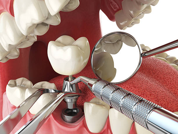Best Emergency Gum Treatment in Stanton, CA